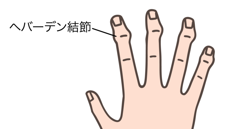へバーデン結節について