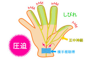 手根管症候群の説明図