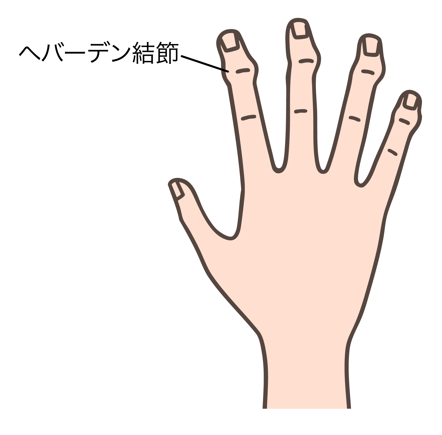 ヘバーデン結節で変形した指