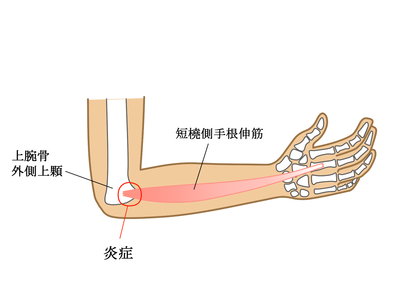 テニス肘の症状