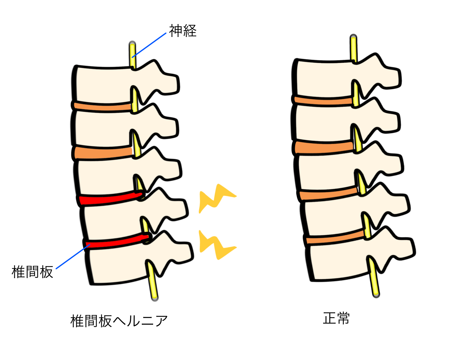 正常な背骨と椎間板ヘルニアを発症した背骨