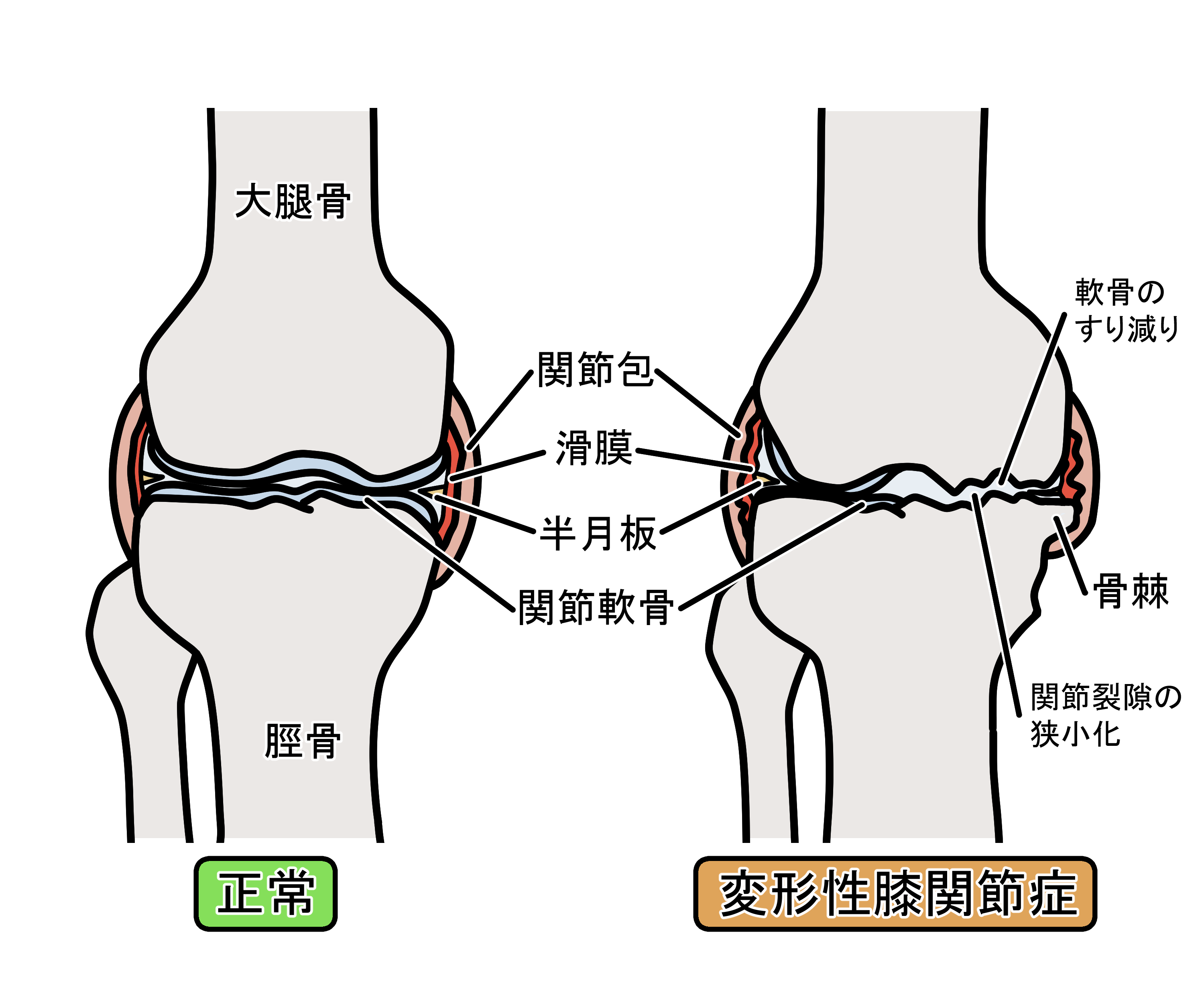 正常な骨と変形性膝関節症の骨