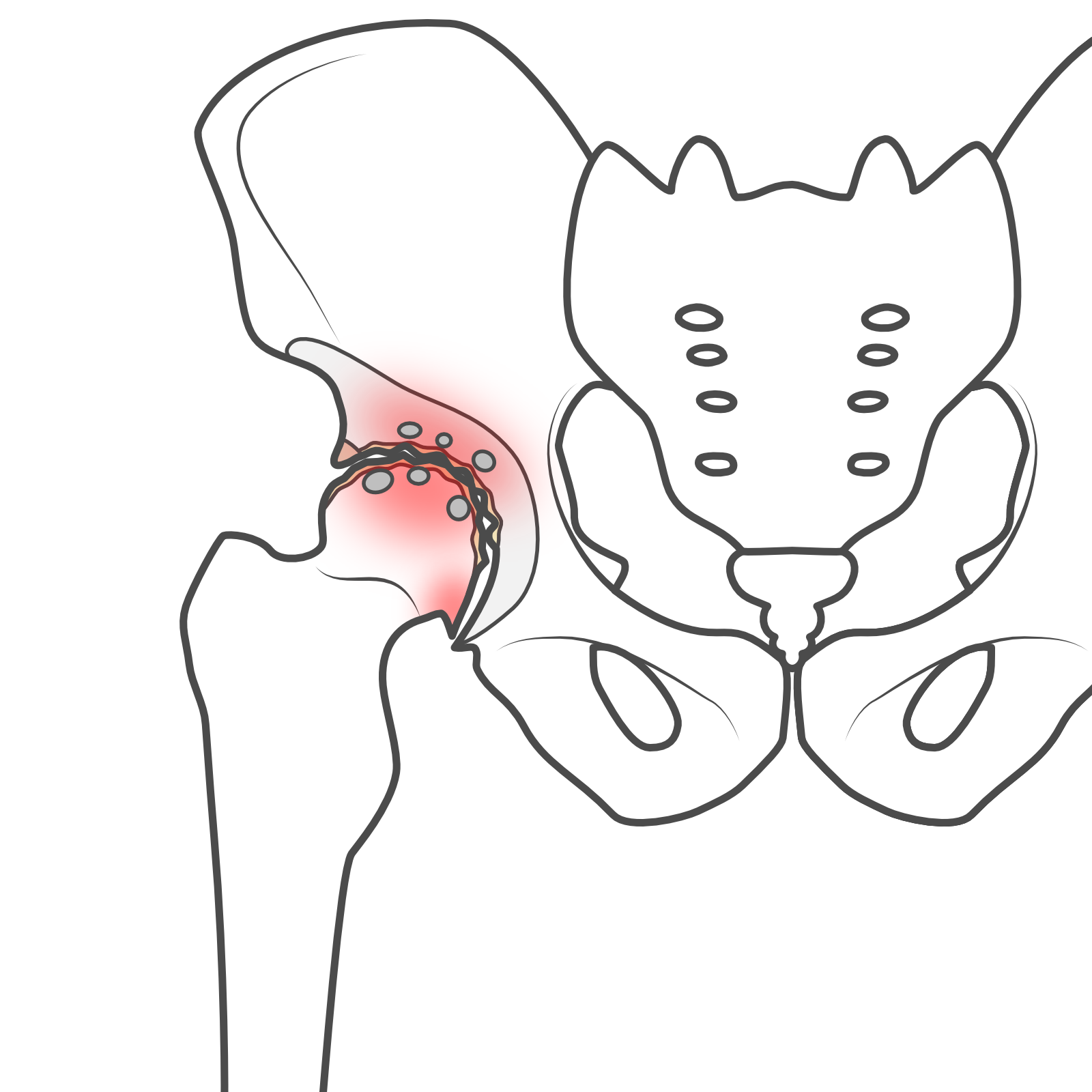 変形性股関節症(進行期)