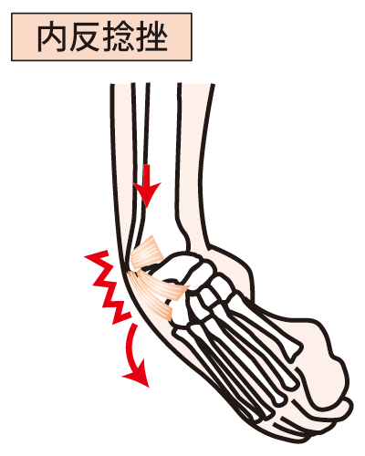 内半捻挫の症状