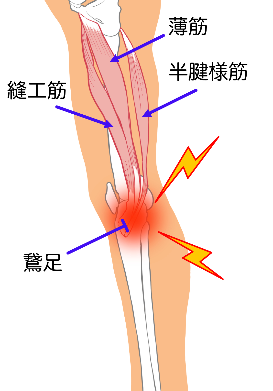 鵞足炎の症状