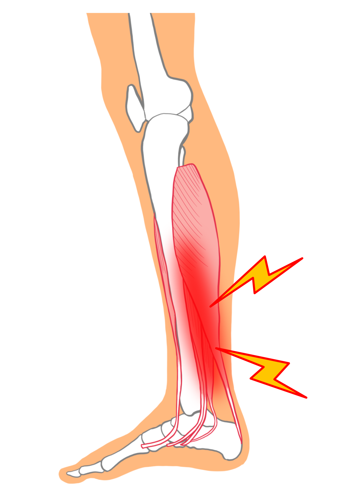 シンスプリントの原因