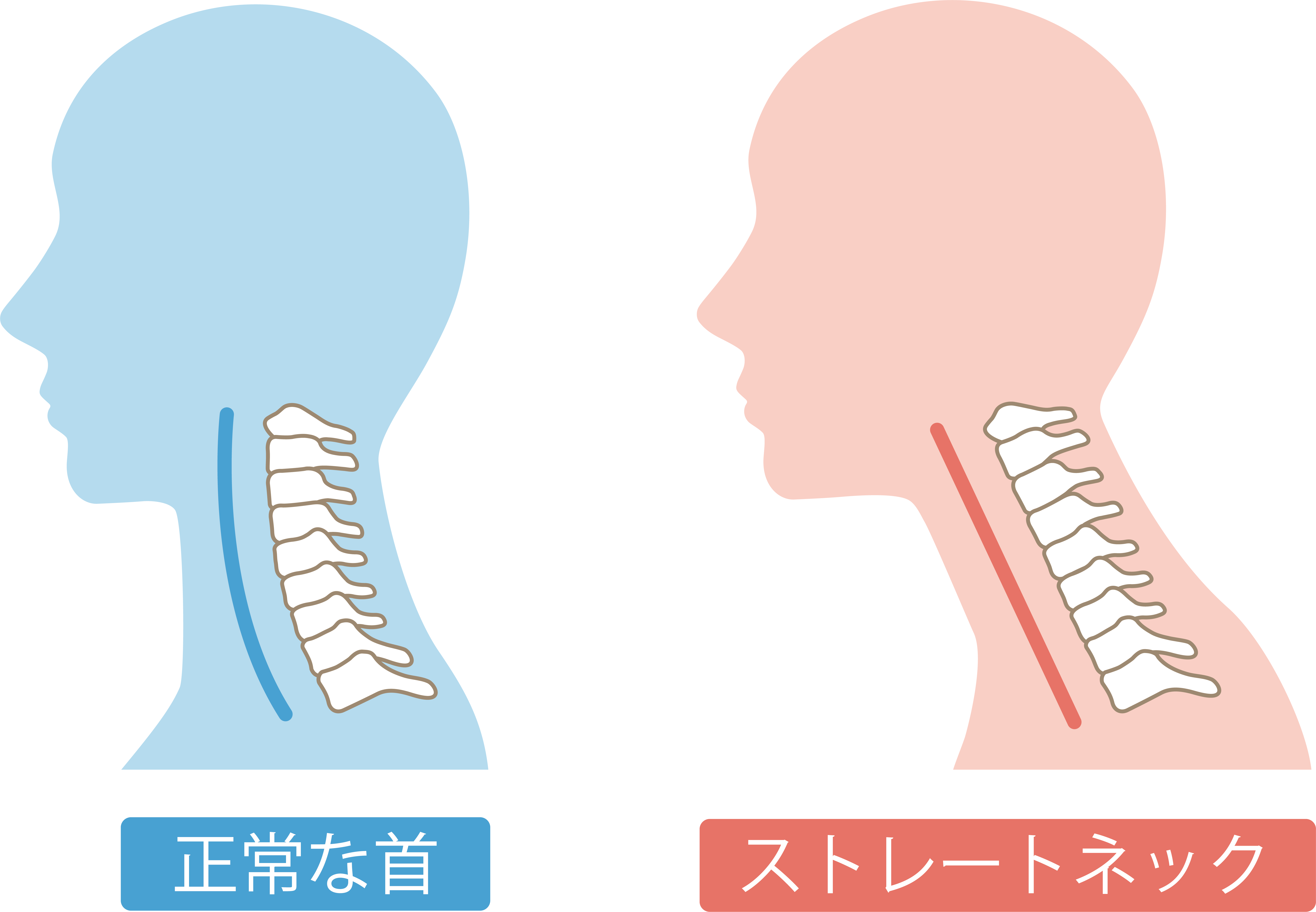 正常な首とストレートネックの首