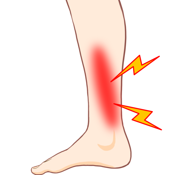 シンスプリントについて