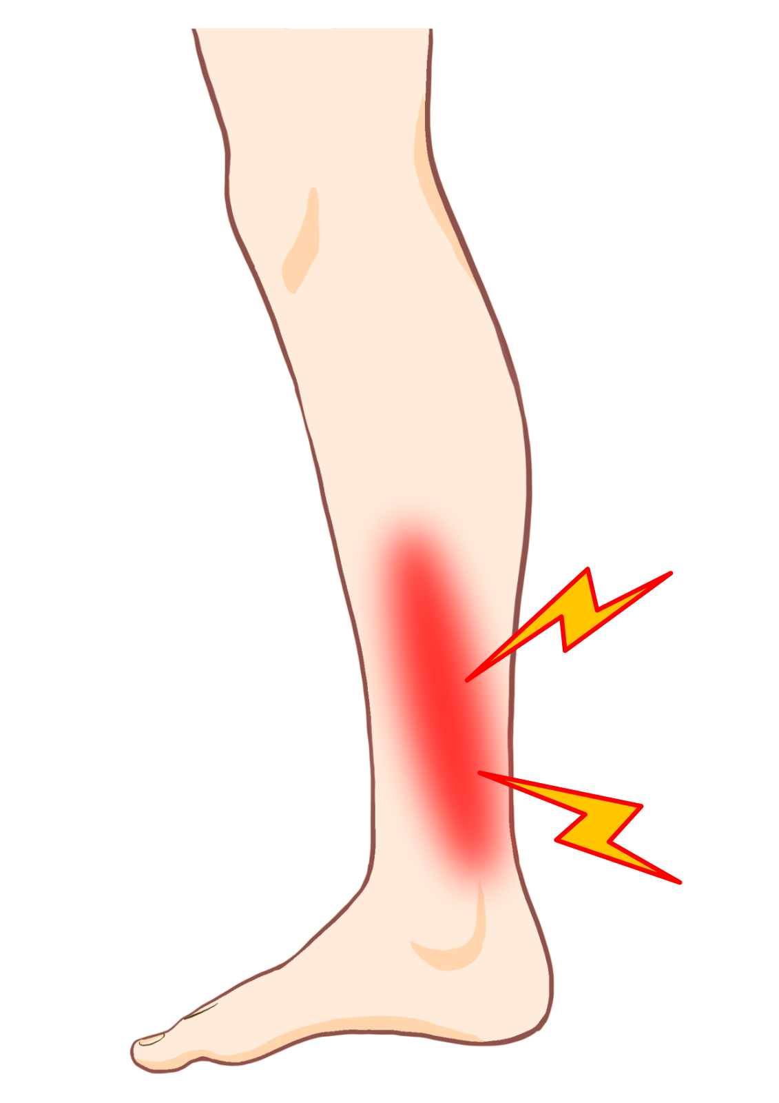 シンスプリントの症状