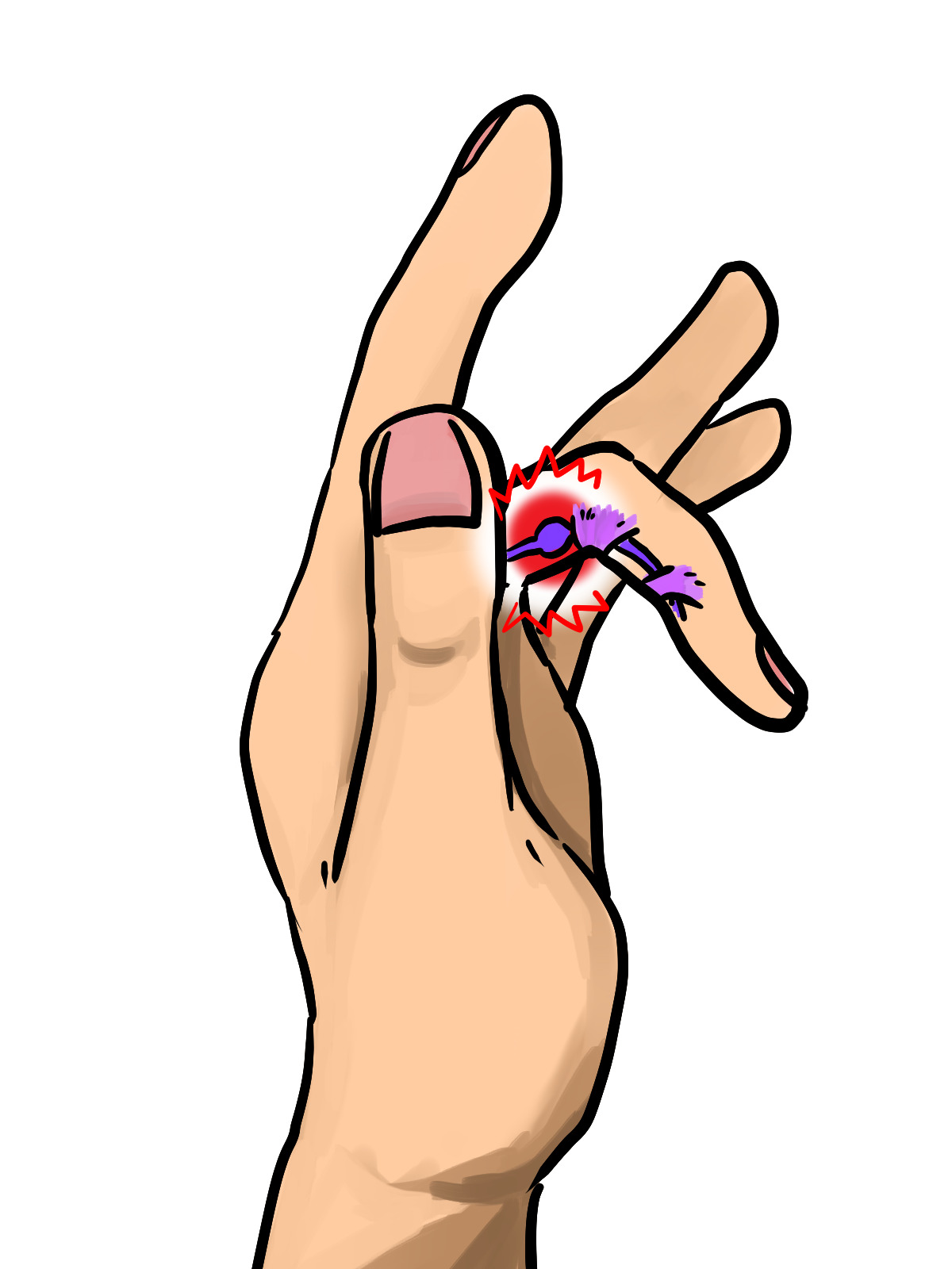 ばね指を発症した手