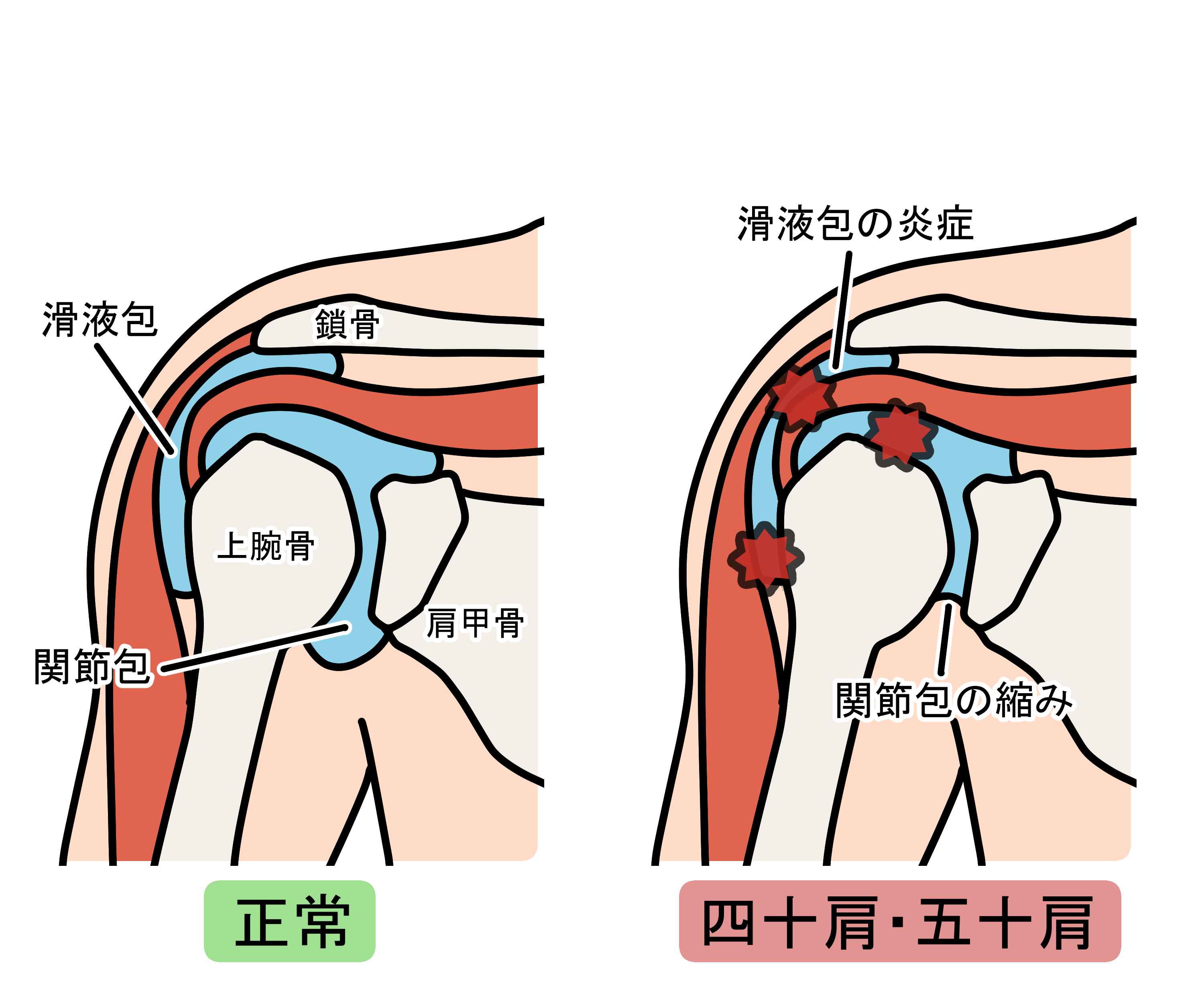正常な肩と、五十肩/四十肩の肩