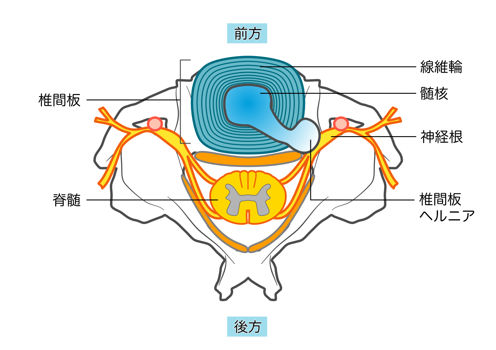 頸椎椎間板ヘルニアの図式