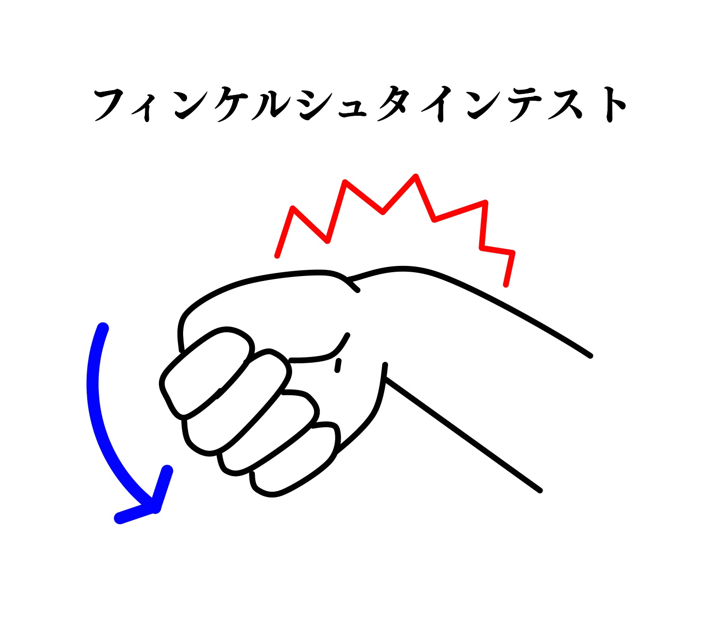 フィンケルシュタインテストの図