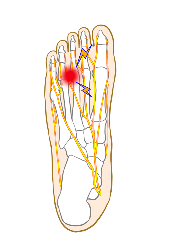 モートン病について