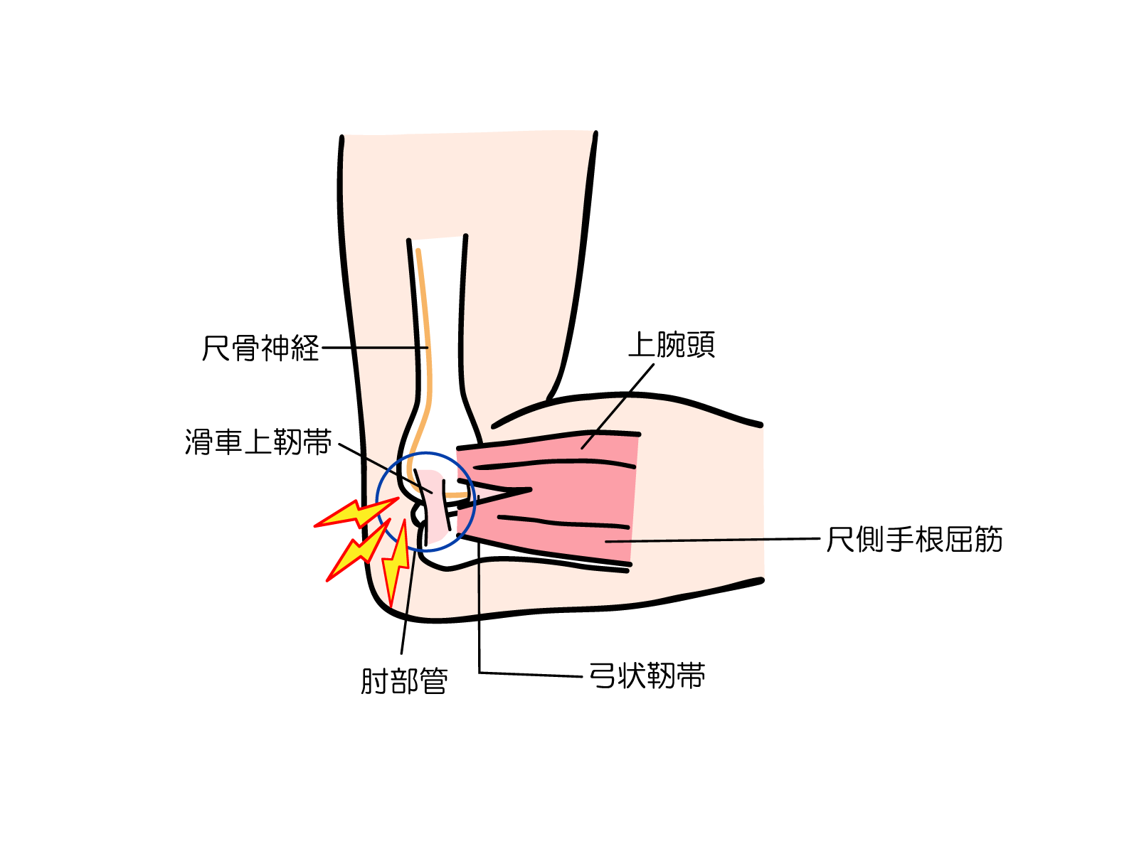 肘部管と尺骨神経