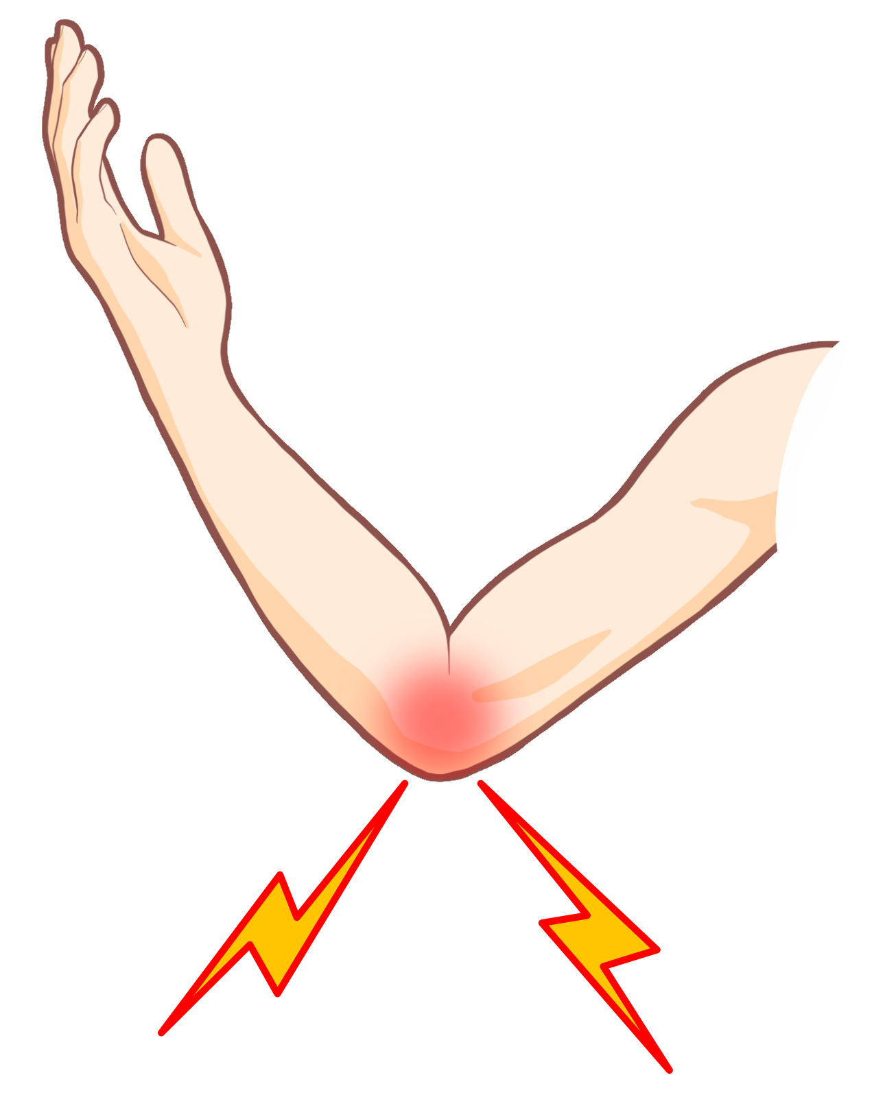 上腕骨内側上顆炎（ゴルフ肘）
