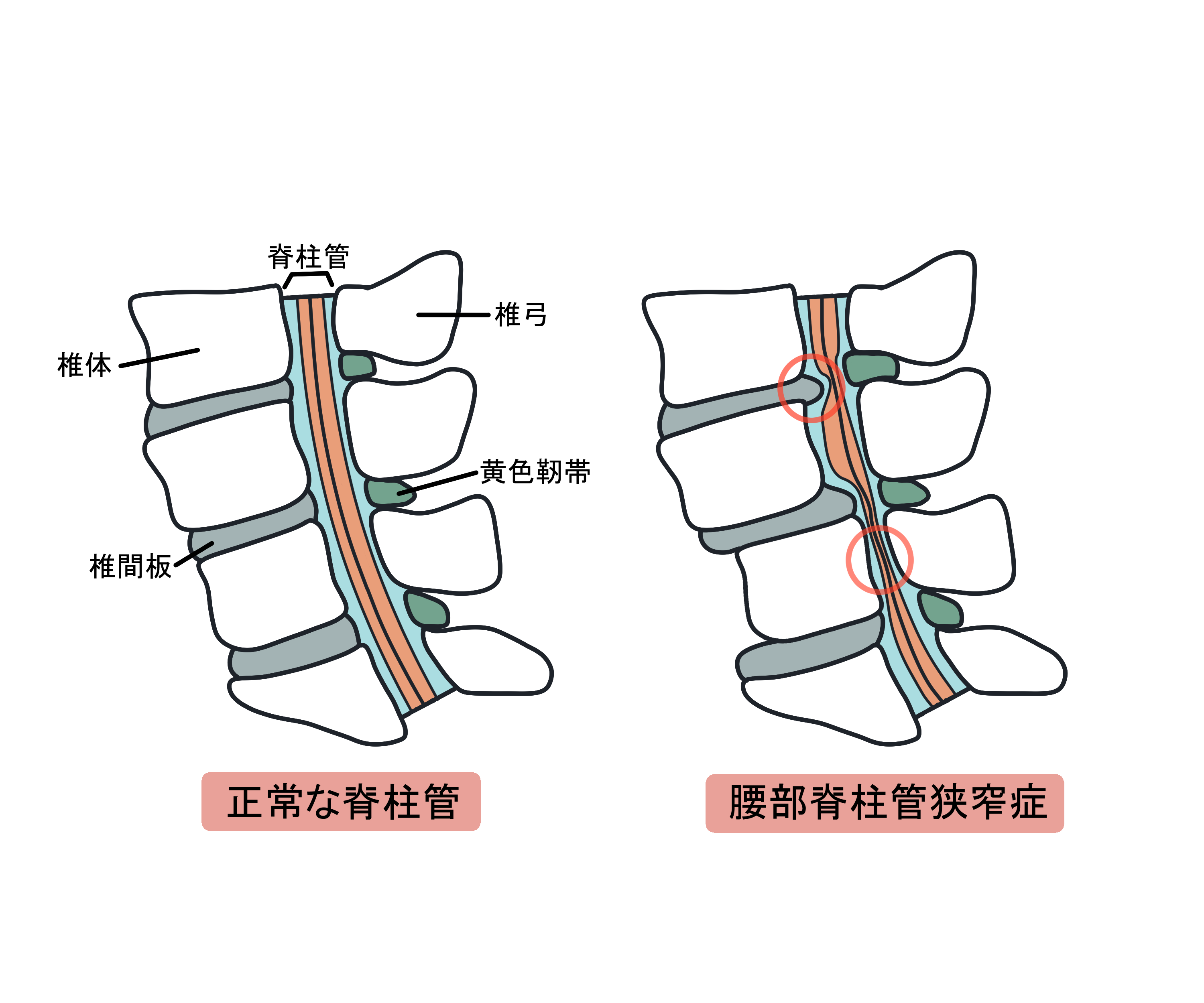 正常な脊柱管と腰部脊柱管狭窄症との比較