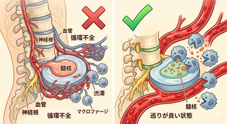 身体に備わる「お掃除機能」とは？飛び出した椎間板ヘルニアが自然に吸収されるための条件